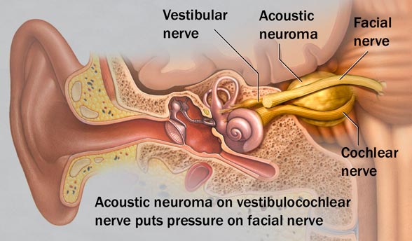 Acousitic-Nerve